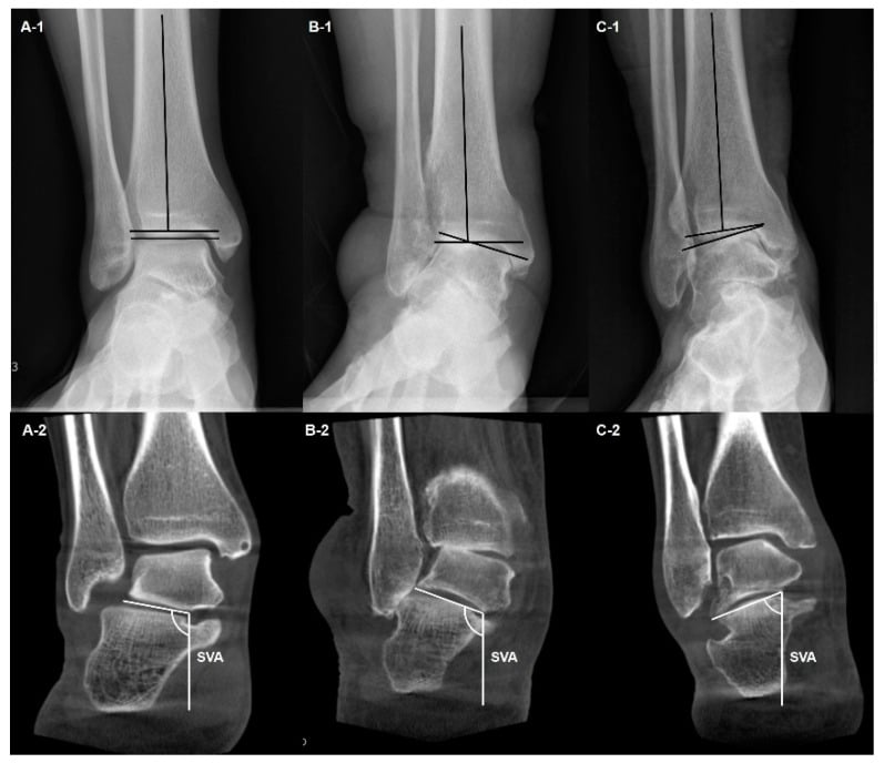 Frontal ankle radiographs and coronal WBCT showing the subtalar vertical angle across three varus ankle patterns