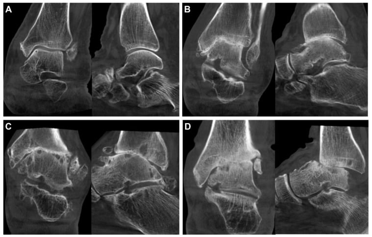 WBCT-based ankle osteoarthritis classification across four grades (A-D), showing progressive osteophyte formation, joint space narrowing, subchondral cysts and articular surface destruction
