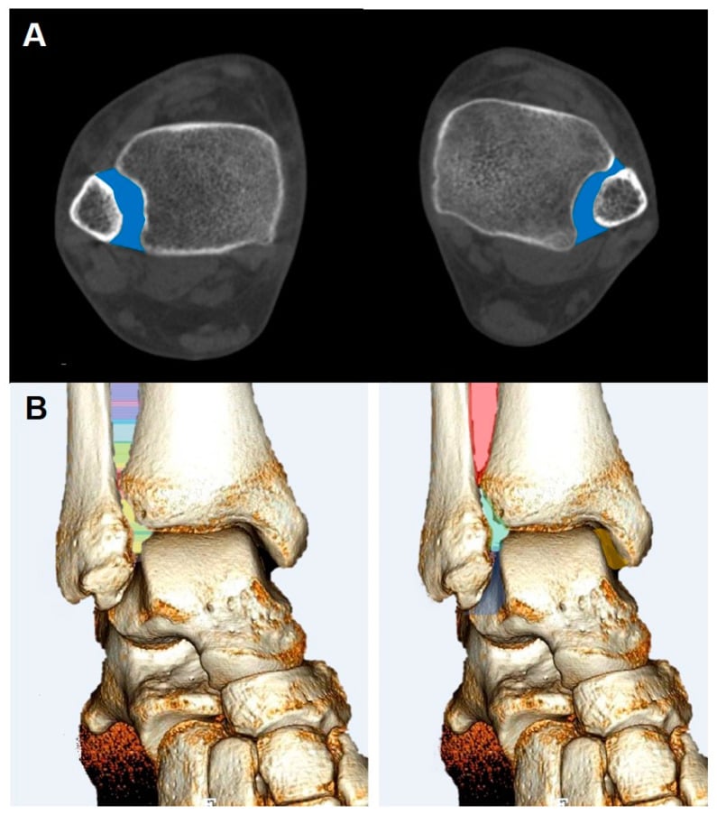 WBCT syndesmosis measurement: axial CT slices with a shaded syndesmotic area overlay, and 3D bone reconstructions with colour-segmented volumetric measurement