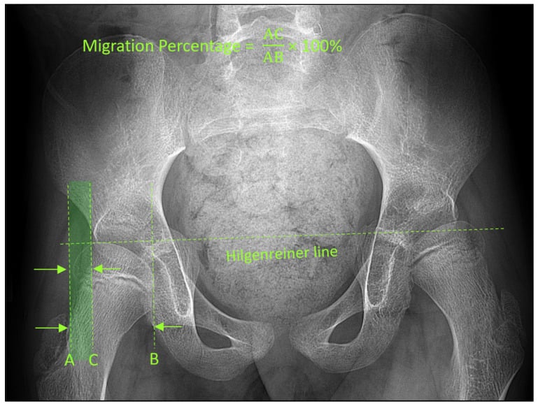 Pelvic radiograph annotated with the Hilgenreiner line and lines A, C and B for migration-percentage measurement