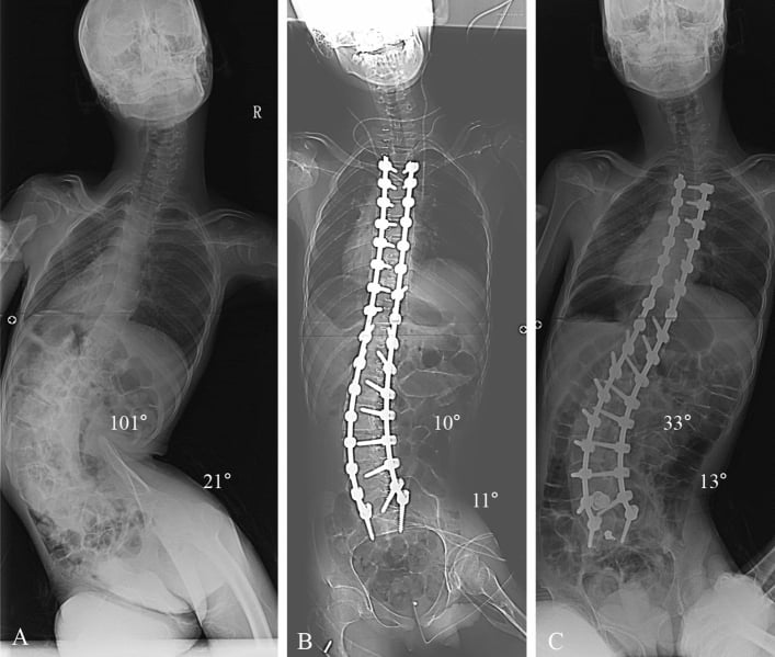 Serial whole-spine radiographs before and after posterior fusion for neuromuscular scoliosis