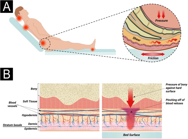 Diagram of pressure, shear and friction on a semi-reclined patient, and of blood vessels pinched off in soft tissue compressed between bone and a hard surface