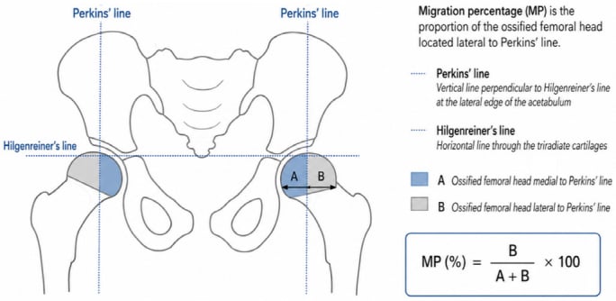 Pelvic schematic showing Hilgenreiner and Perkins lines and Reimers migration percentage