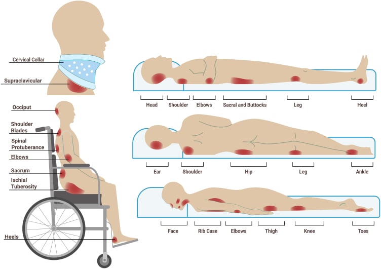 Diagram of pressure-prone bony prominences in sitting and lying positions