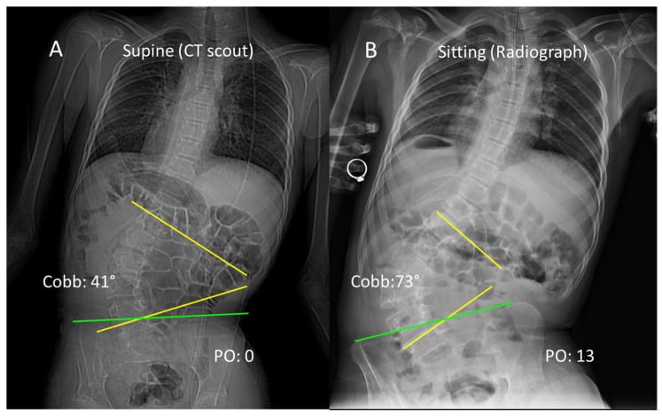 Supine CT scout and sitting spine radiograph comparing Cobb angle and pelvic obliquity