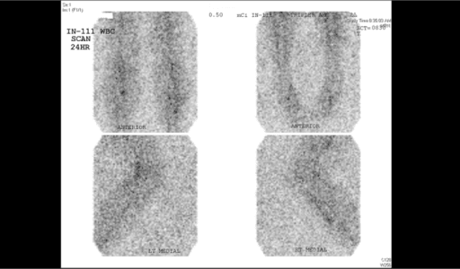 Labelled leukocyte scan showing focal tibial uptake in a chronic osteomyelitis scenario.