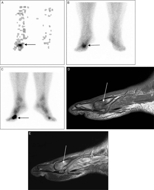 Three-phase bone scan from a diabetic foot infection work-up, illustrating why bone scan alone lacks specificity.