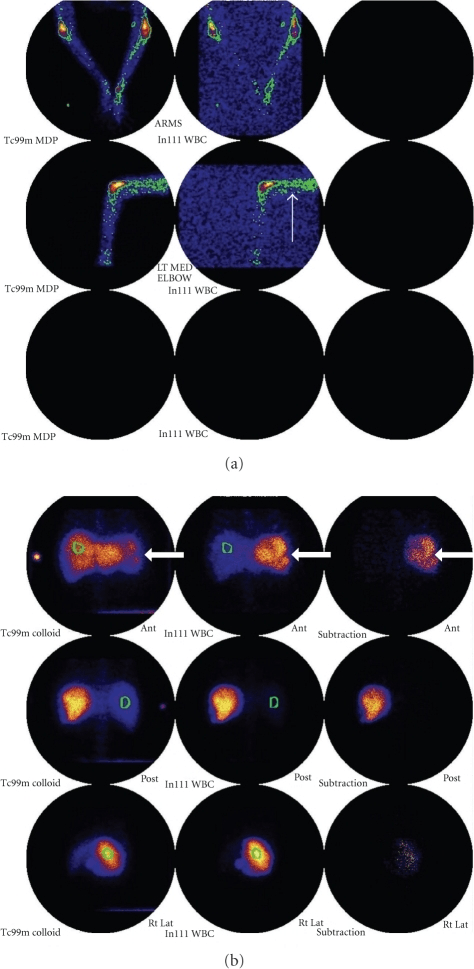 Multi-tracer infection scintigraphy panels: Tc-99m MDP bone scan, In-111-labelled leukocyte images with focal uptake, and Tc-99m sulfur-colloid marrow images with subtraction views.