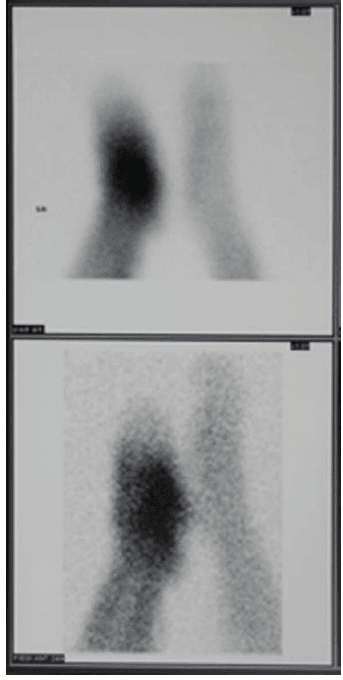 Leukocyte scan of the foot showing focal uptake concerning for osteomyelitis.