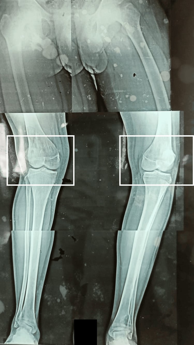 Standing bilateral knee radiograph showing genu valgus in one knee and genu varus in the other - the windswept deformity pattern