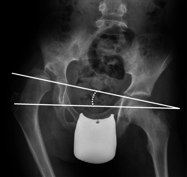 Pelvic radiograph demonstrating measurement of pelvic obliquity in cerebral palsy