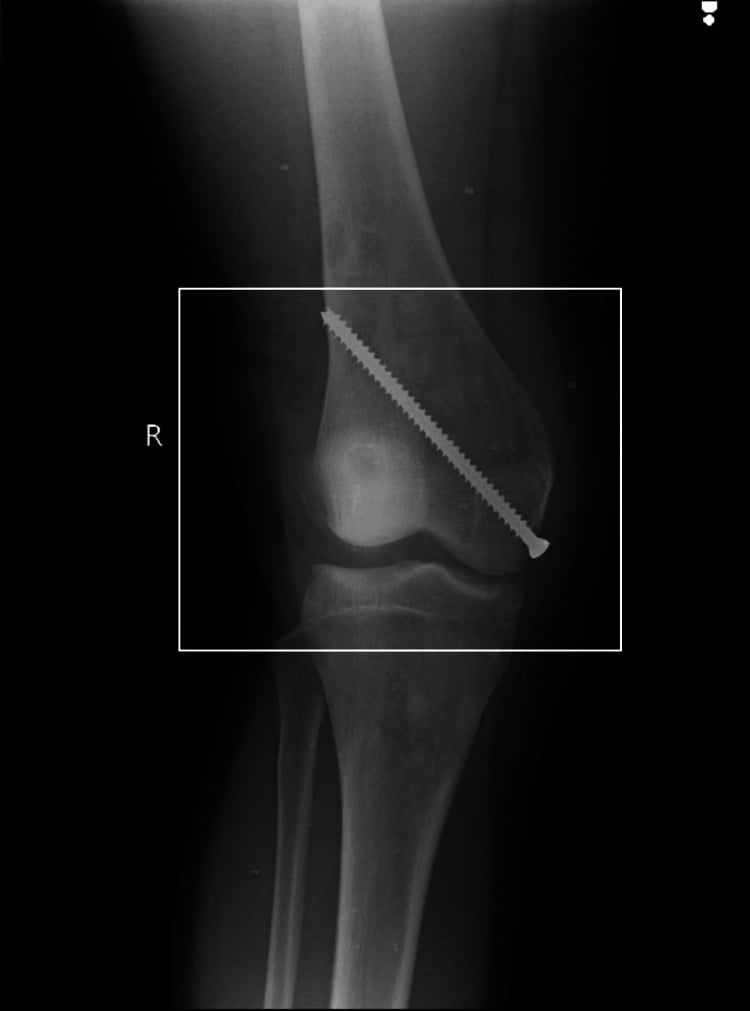 Radiograph of distal-femoral cannulated-screw hemiepiphysiodesis