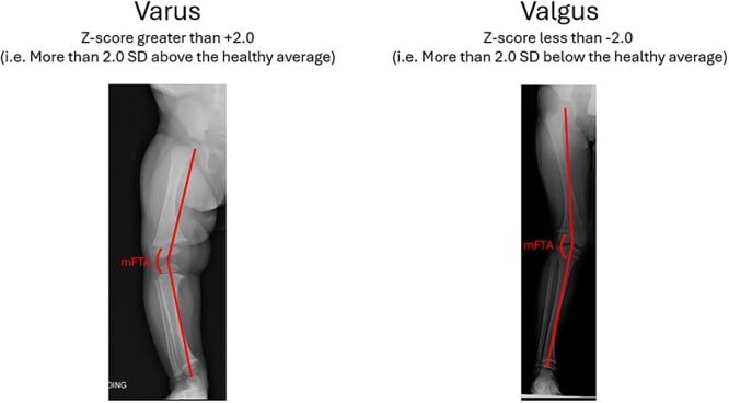 Mechanical femorotibial angle measurement for varus and valgus alignment