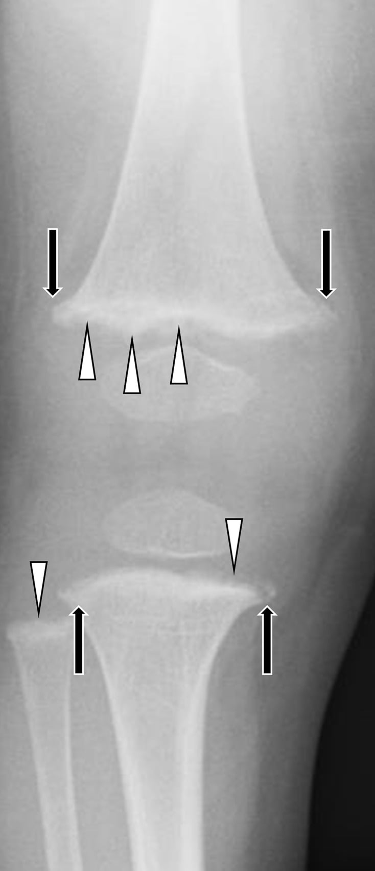 Knee radiograph showing metaphyseal fraying and splaying from rickets