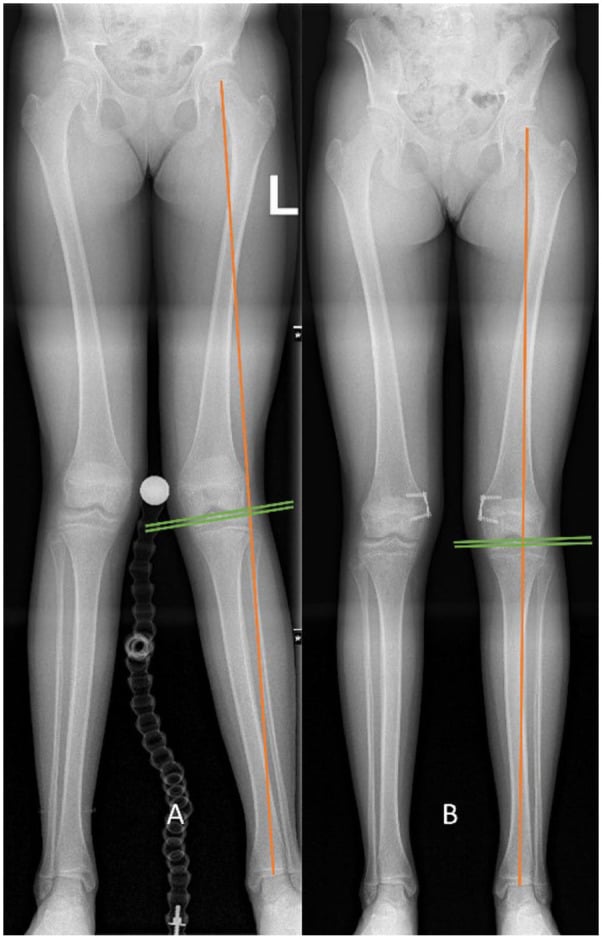 Pre- and post-treatment radiographs of medial guided growth for genu valgum