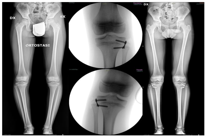 Serial radiographs of lateral tibial hemiepiphysiodesis for genu varum