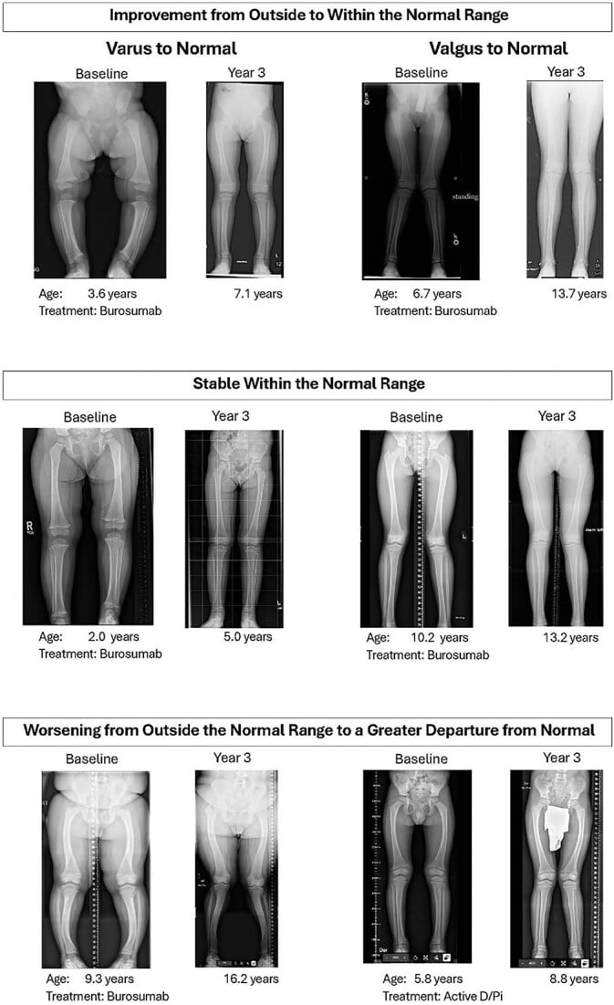 Serial full-length radiographs showing different XLH alignment outcomes over three years