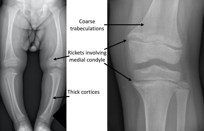 Lower-limb and knee radiographs showing X-linked hypophosphataemic rickets