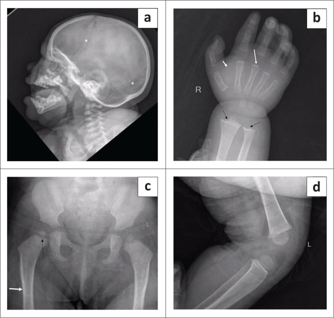 Lateral skull with Wormian bones beside a wrist radiograph with delayed carpal ossification.