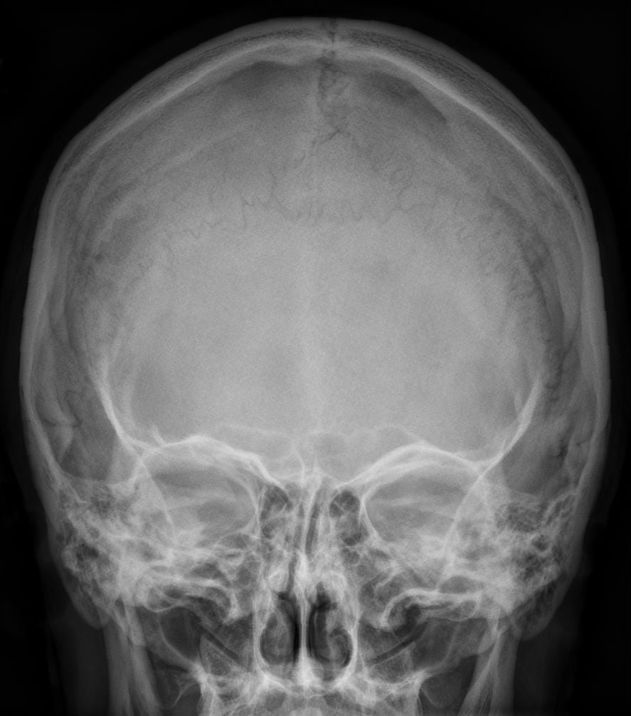Lateral skull radiograph with a single large triangular bone between the occipital bone and the parietals.