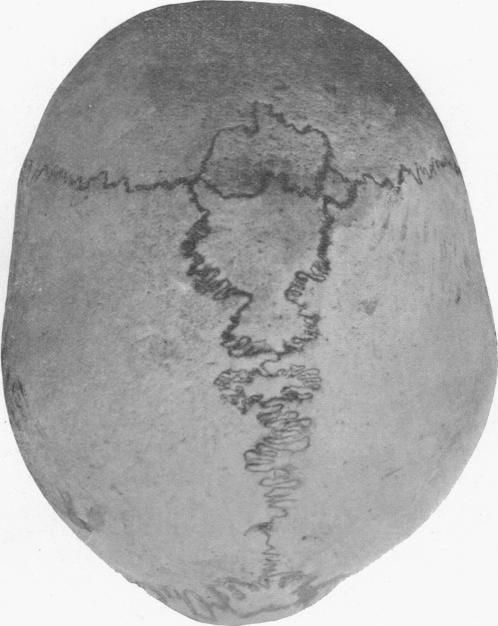 Dry human skull viewed from behind, lambdoid suture filled with many small sutural bones.