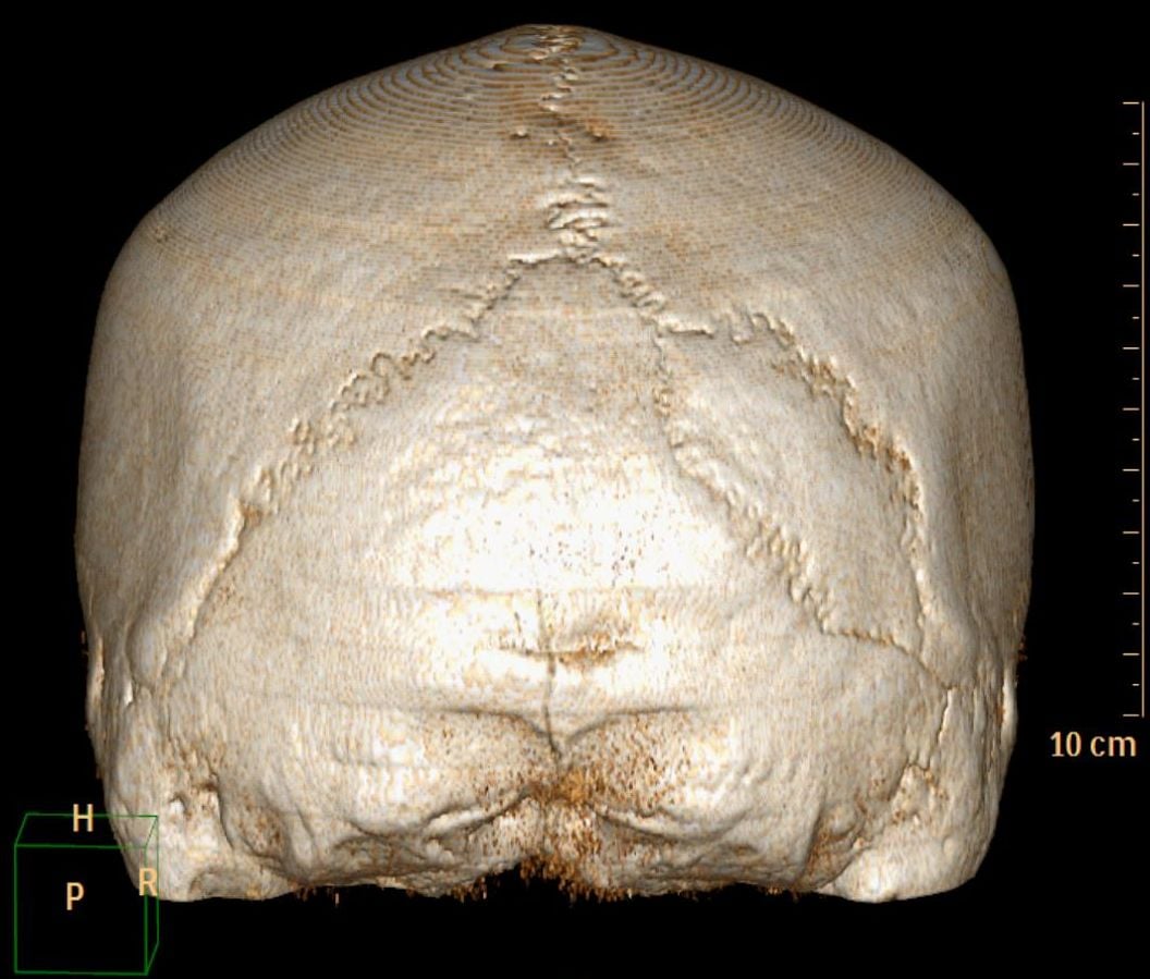 Volume-rendered CT of the posterior skull showing a Wormian bone in the lambdoid suture.