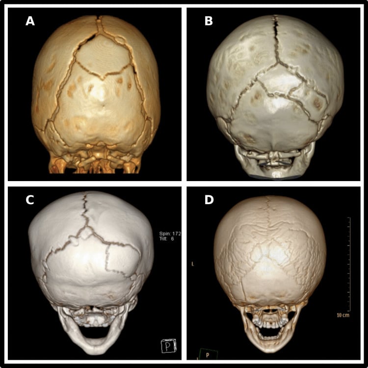Four three-dimensional CT reconstructions of paediatric skulls showing from one lambdoid ossicle to a mosaic of many.
