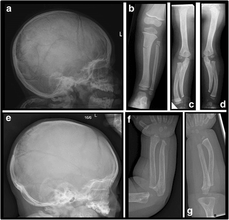 Lateral skull radiograph of a young child showing an open anterior fontanelle and several small bones near the lambda.