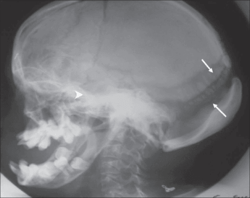 Lateral skull radiograph showing multiple small intrasutural bones, widened sutures and an enlarged pituitary fossa.