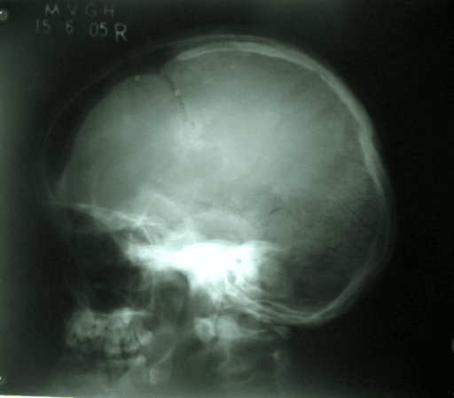 Lateral skull radiograph showing widely open sutures, large fontanelles and multiple intrasutural bones.