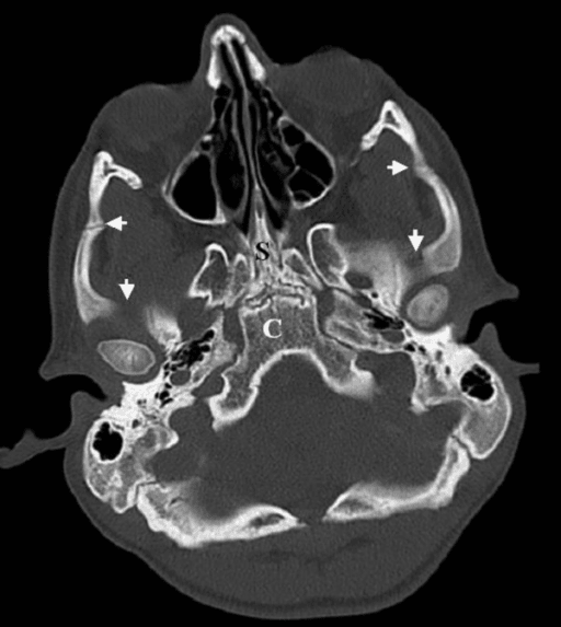 Axial three-dimensional CT reconstruction of the skull base showing extensive bony destruction.