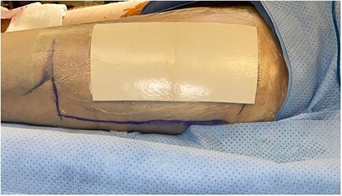 Intraoperative photograph of a skin graft donor site with dressings in place
