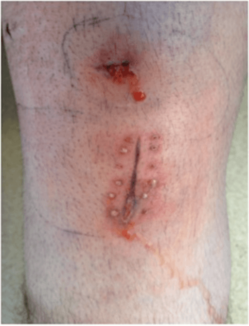 Clinical photograph of a surgical wound on postoperative day eleven showing breakdown