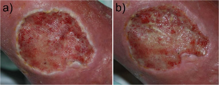 Clinical photographs of a venous leg ulcer at baseline and during treatment