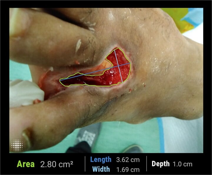 Clinical photograph of a chronic diabetic foot ulcer with wound measurement overlay