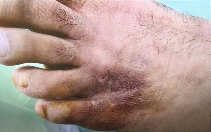 Clinical photograph showing complete epithelialisation of a diabetic foot ulcer at eight weeks