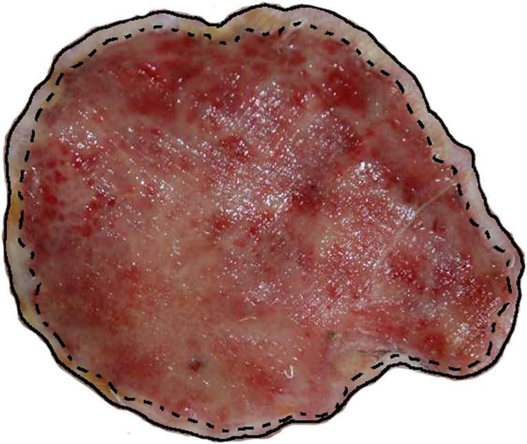 Clinical photograph with planimetric delineation of a chronic skin defect