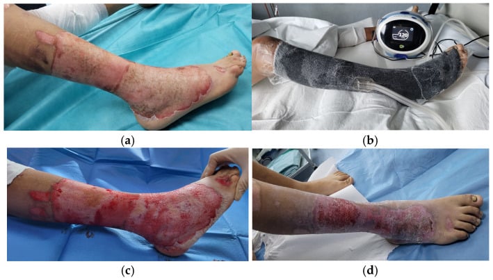 Photographs of lower limb burns at admission, under negative pressure wound therapy, and after five days