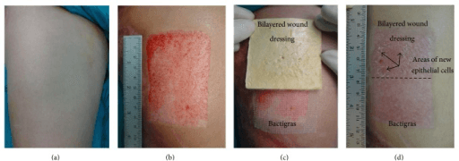 Photographs of a split-thickness skin graft donor site before harvest, after harvest and dressed