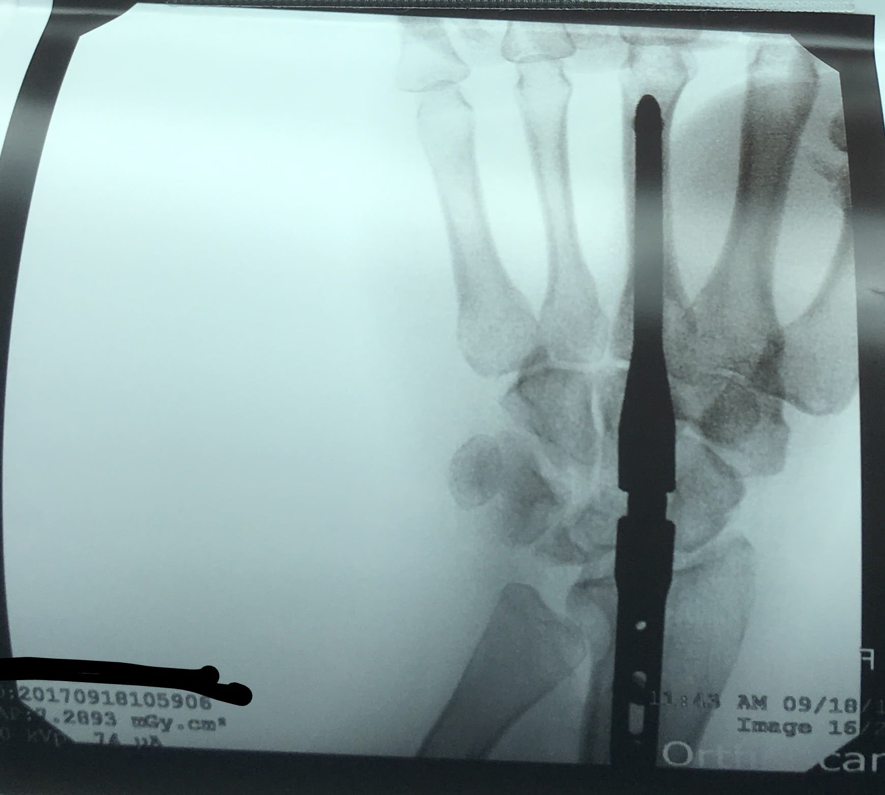 PA radiograph of a right wrist after total arthrodesis with a central intramedullary rod spanning the third metacarpal, carpus and distal radius.