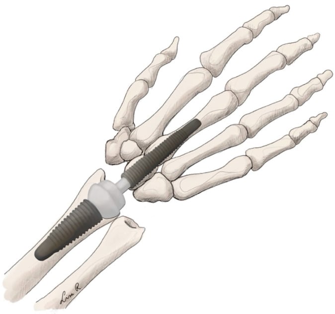 Anatomical illustration of a ball-and-socket total wrist arthroplasty implant.