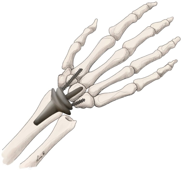 Anatomical illustration of an ellipsoid total wrist arthroplasty implant.