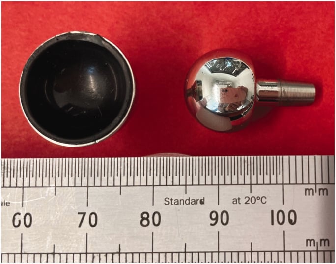 Explant photograph of a total wrist metacarpal head and radial cup showing rim damage.