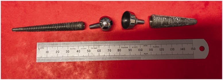 Separated modular components of an explanted contemporary total wrist prosthesis.