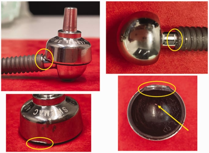 Composite explant photographs showing rim impingement and wear in a total wrist prosthesis.