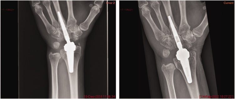 Serial wrist radiographs, labelled Prior 2 (2018) and Current (2022), showing progression from a well-fixed metacarpal stem to osteolysis and subsidence.
