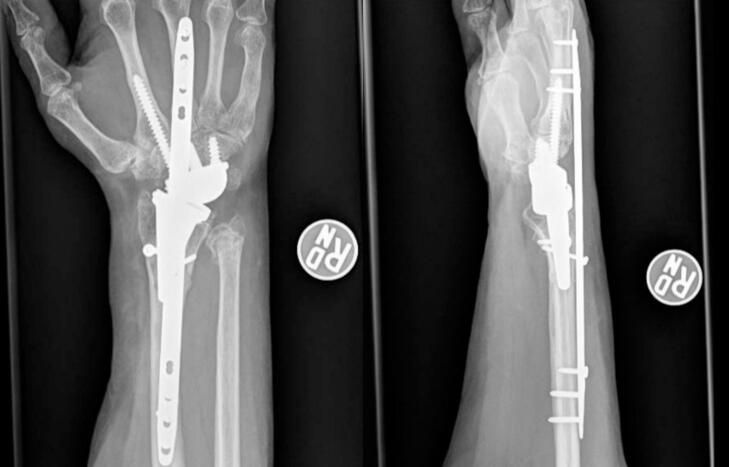 Follow-up PA and lateral wrist radiographs showing healing periprosthetic fractures with the bridge plate and wrist prosthesis in place.