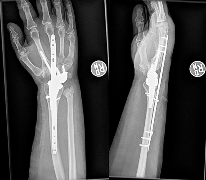 One-week postoperative PA and lateral wrist radiographs after bridge plating of the radius, with the wrist prosthesis retained.