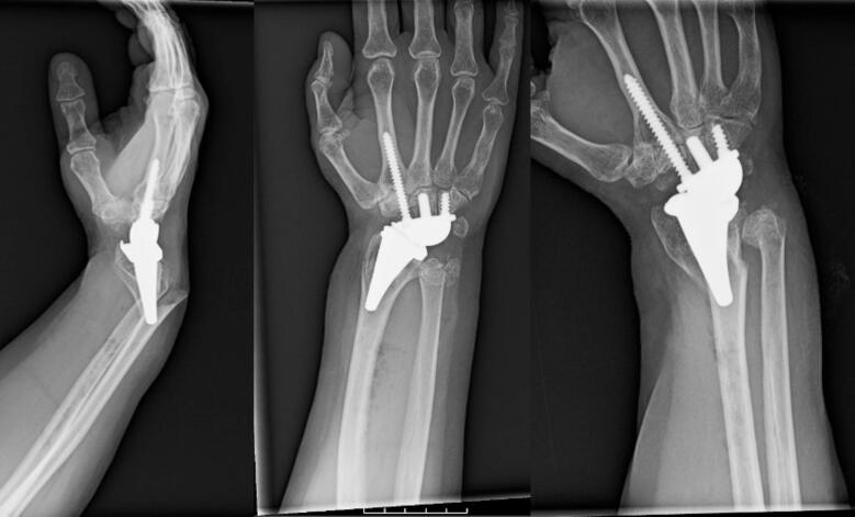 Three wrist radiographs, including a lateral view, showing peri-implant distal radius and ulna fractures around a total wrist arthroplasty.
