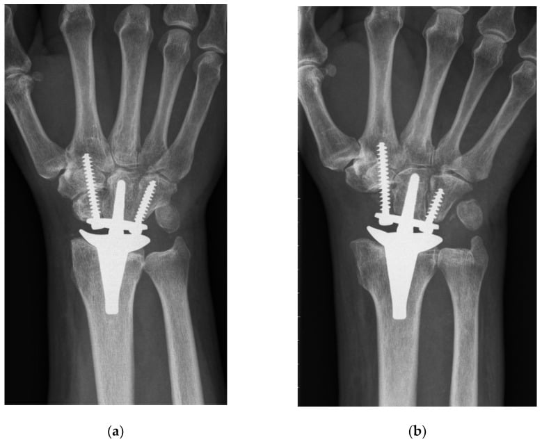 Postoperative radiographs comparing conventional carpal resection and proximal-row carpectomy total wrist arthroplasty.